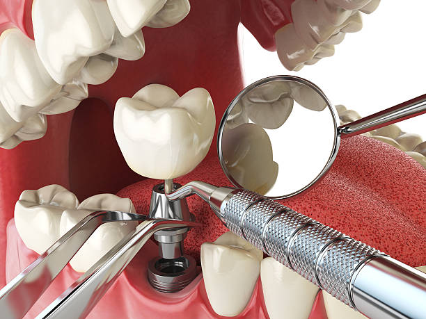 Best Emergency Wisdom Teeth Removal in Samsula Spruce Creek, FL
